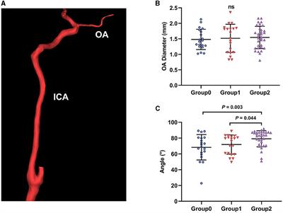 Effect of PCI on ophthalmic artery hemodynamics in patients with acute coronary syndrome